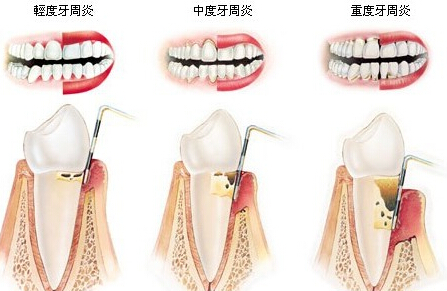 牙周病到底是如何形成的？